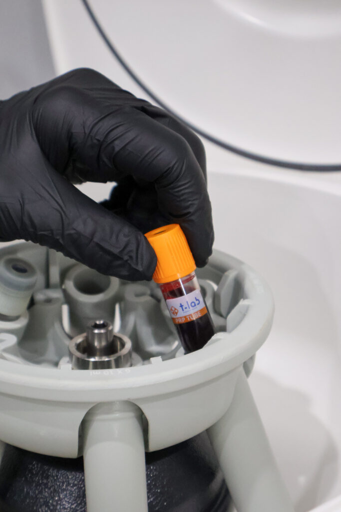 revita med clinic prp tube