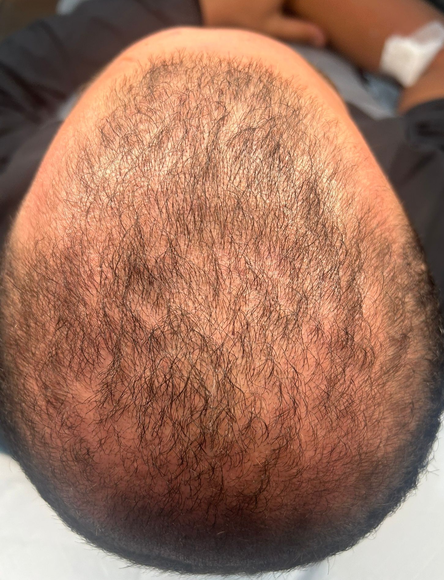 Before PRP hair treatment - male patient with thinning crown area