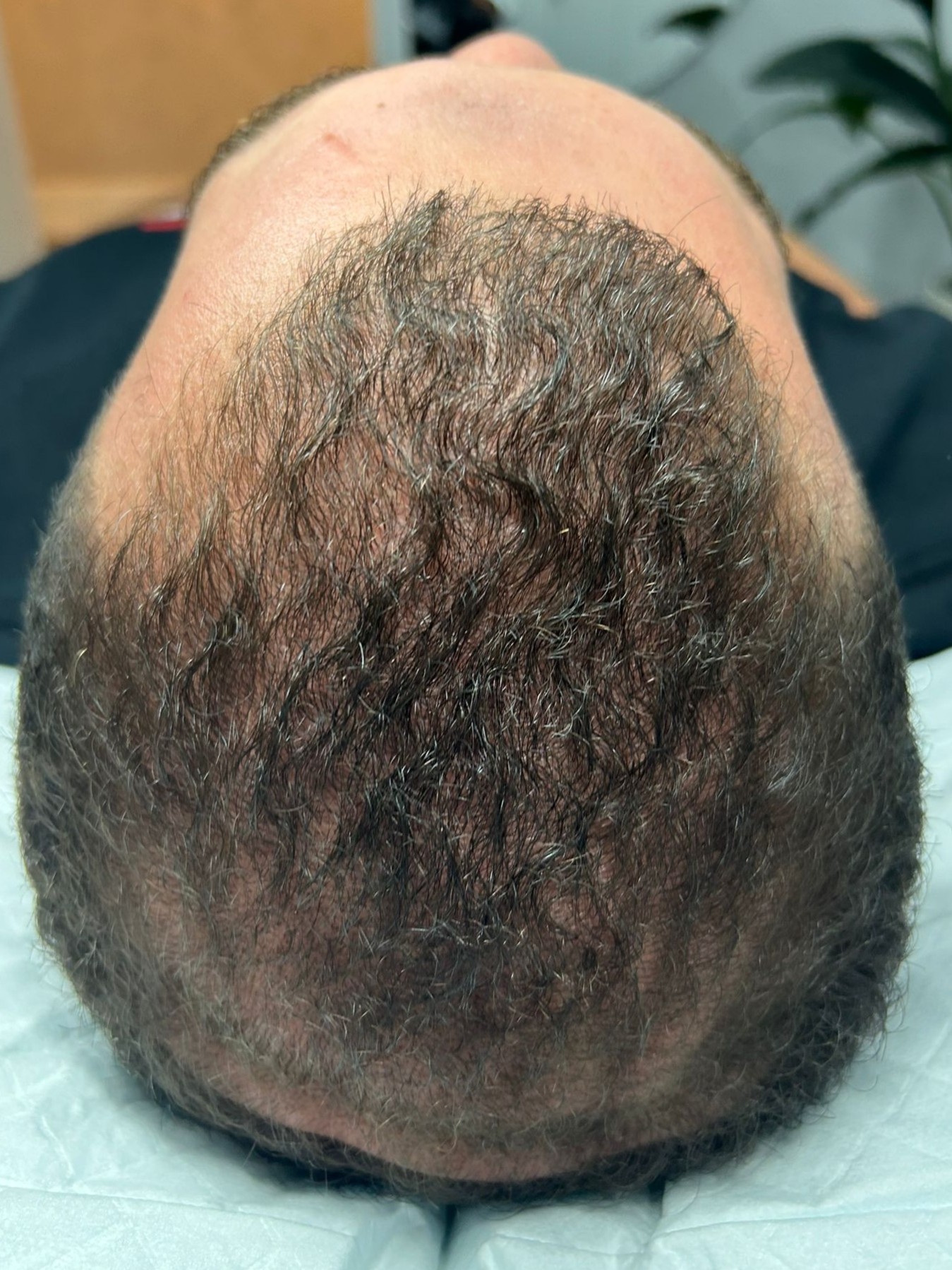 After PRP hair treatment - visible hair regrowth on crown after sessions at ReVita Med Clinic Revesby